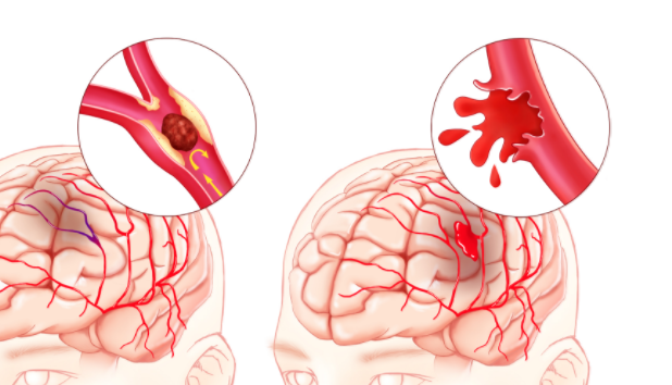 缺血性中风与出血性中风