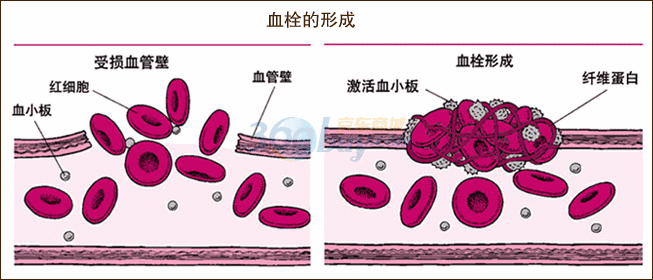 血栓的形成