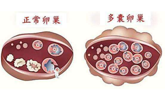 正常卵巢和多囊卵巢