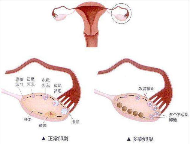 正常卵巢和多囊卵巢的卵子发育过程