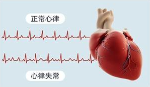 心律不齐怎么办？可以用缺血预适应训练仪治疗吗