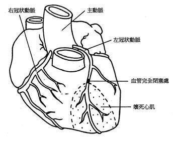 什么是心绞痛有什么表现,具体的疼痛位置在哪里