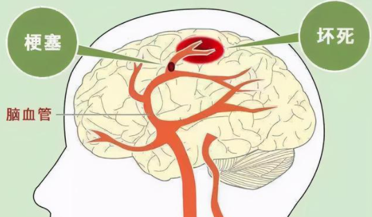 脑血栓和脑梗的区别及前兆表现和发病原因,怎么治疗吃什么好
