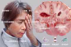 脑卒中是什么意思拼音怎么读,脑卒中早期6大症状