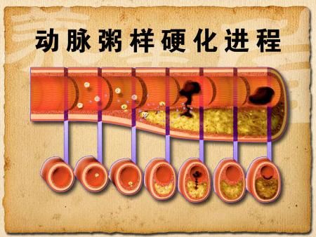 动脉硬化过程