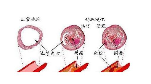 动脉硬化与正常动脉区别