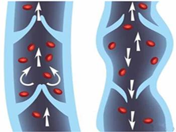 正常静脉瓣及静脉瓣功能不全（右）