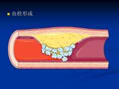 血栓的症状是什么怎么回事,血栓怎么治疗及是形成的