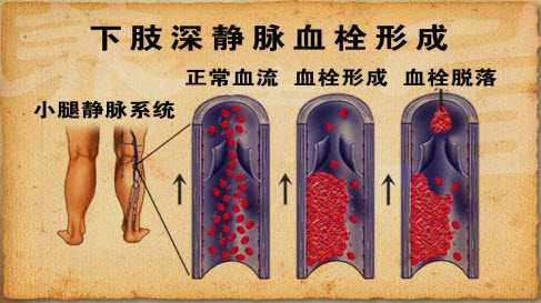 静脉血栓