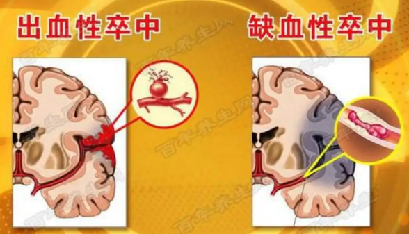 脑卒中和脑溢血、脑梗、脑血栓有什么区别和前兆症状