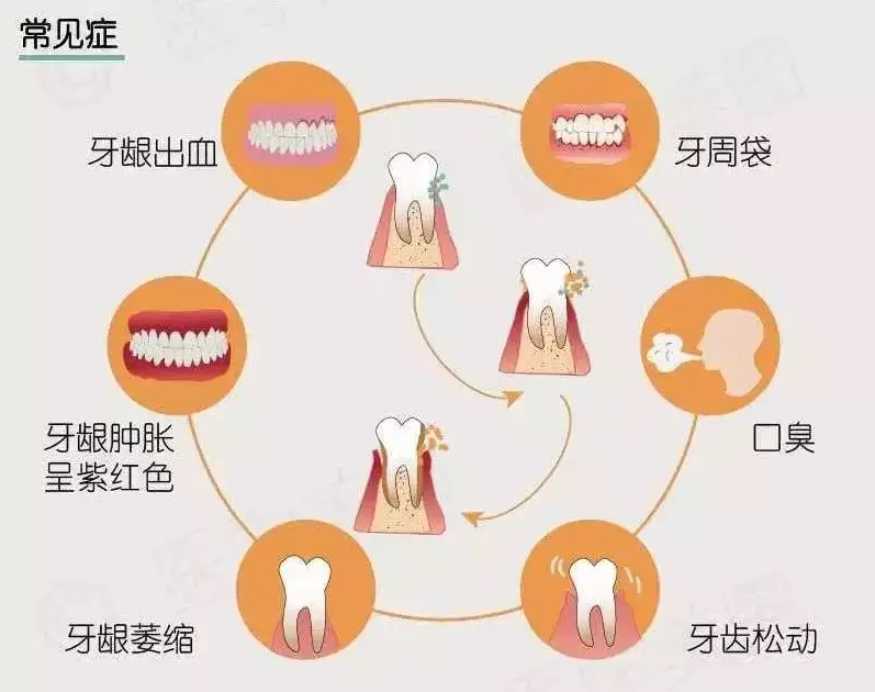 牙周炎常见症状