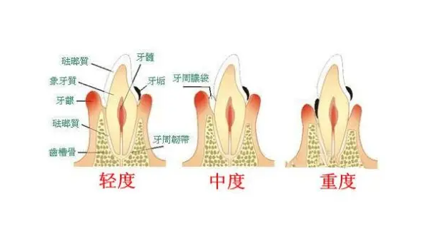 牙周炎轻症到重症