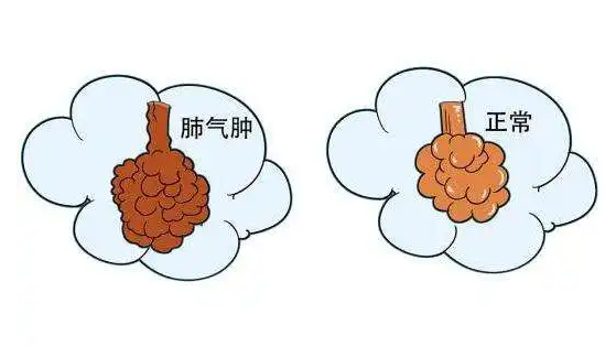肺气肿是什么，有哪些症状怎么治疗